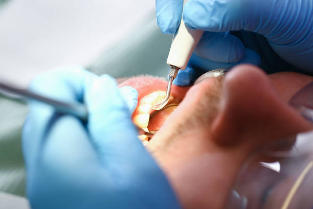 Best Dental Abscess Treatment in Asheville, NC